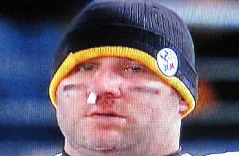Ben Roethlisberger with a broken nose patched up.